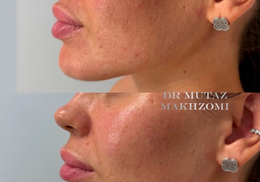 Liposuction