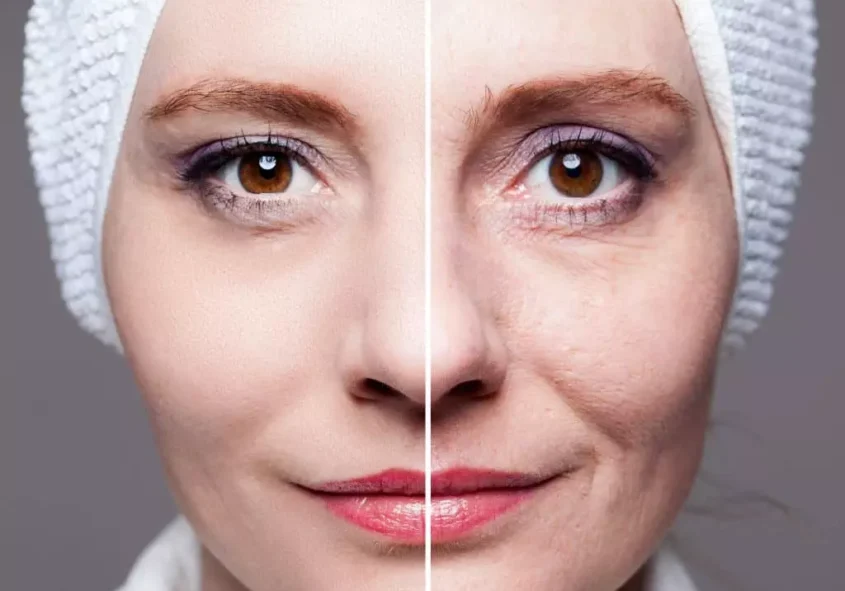 Sculptra treatment by Dr. Mutaz Makhzomi for natural collagen stimulation and facial rejuvenation Professional Sculptra injections to restore facial volume and improve skin firmness Non-surgical facial rejuvenation with Sculptra collagen stimulator treatment